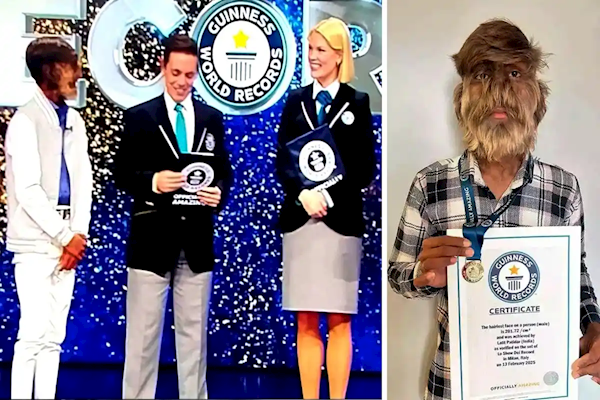 18岁印度少年获得“最毛脸”吉尼斯纪录：脸部95%覆盖毛发图片